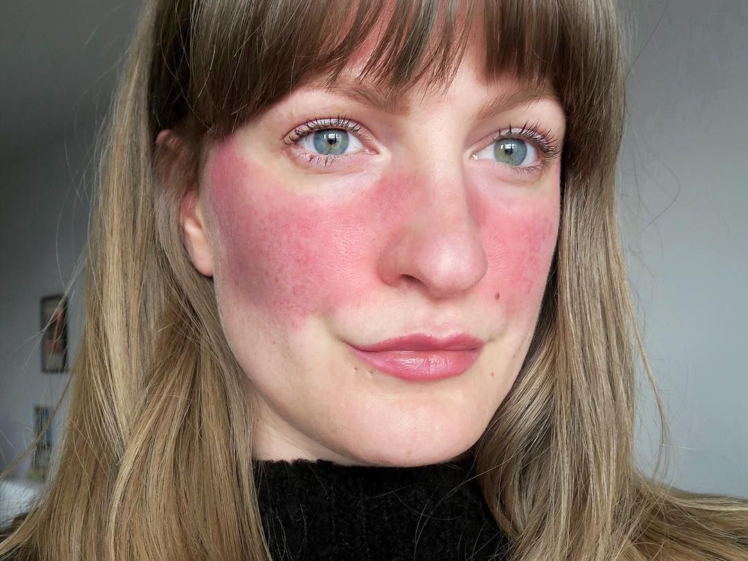 Managing Rosacea After 40: Triggers, Treatments, and the Gut-Skin Connection